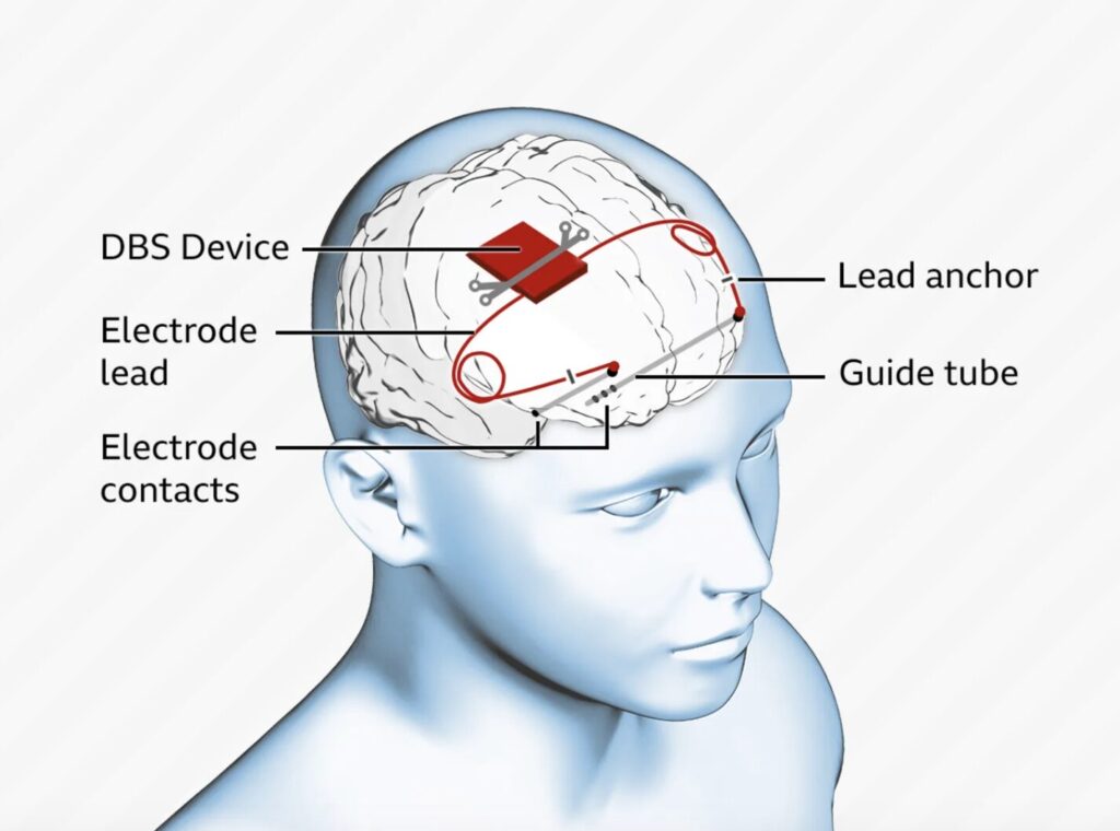 Epilepsy Detection Implants