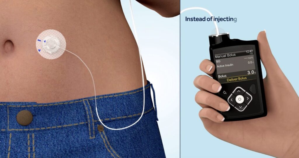 Smart Insulin Pumps