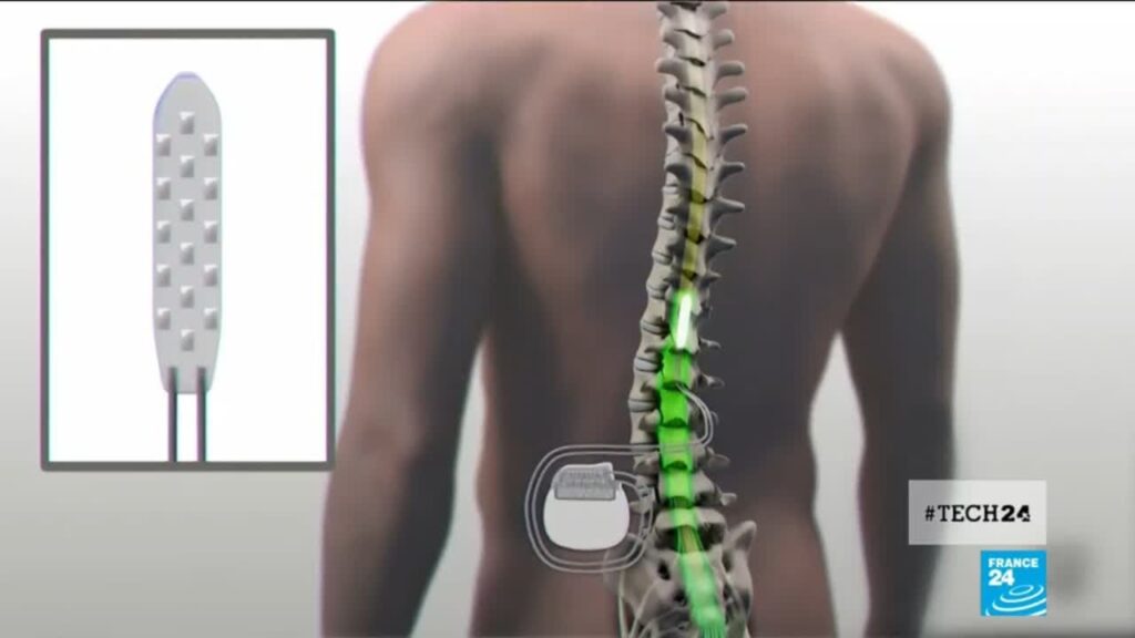 Smart Spinal Implants