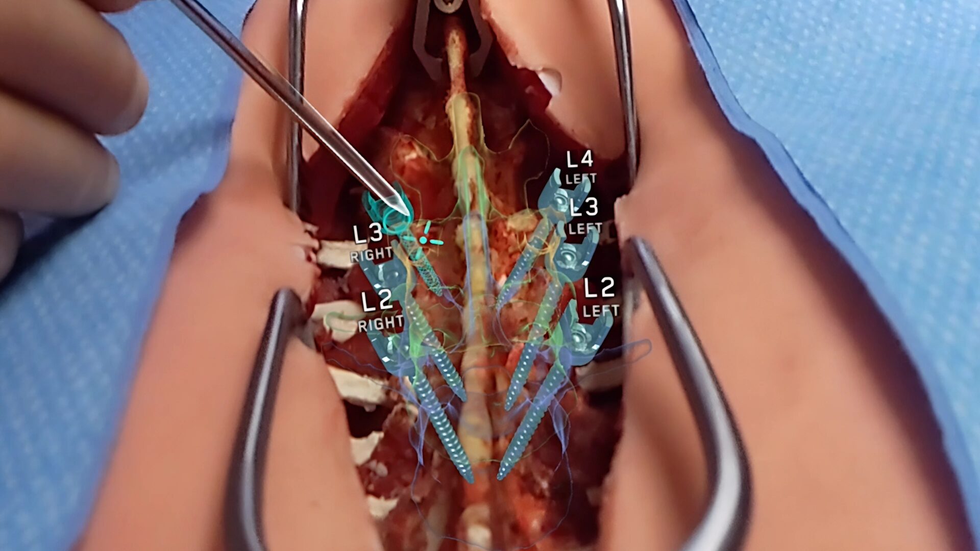 Spine Surgery with Medivis