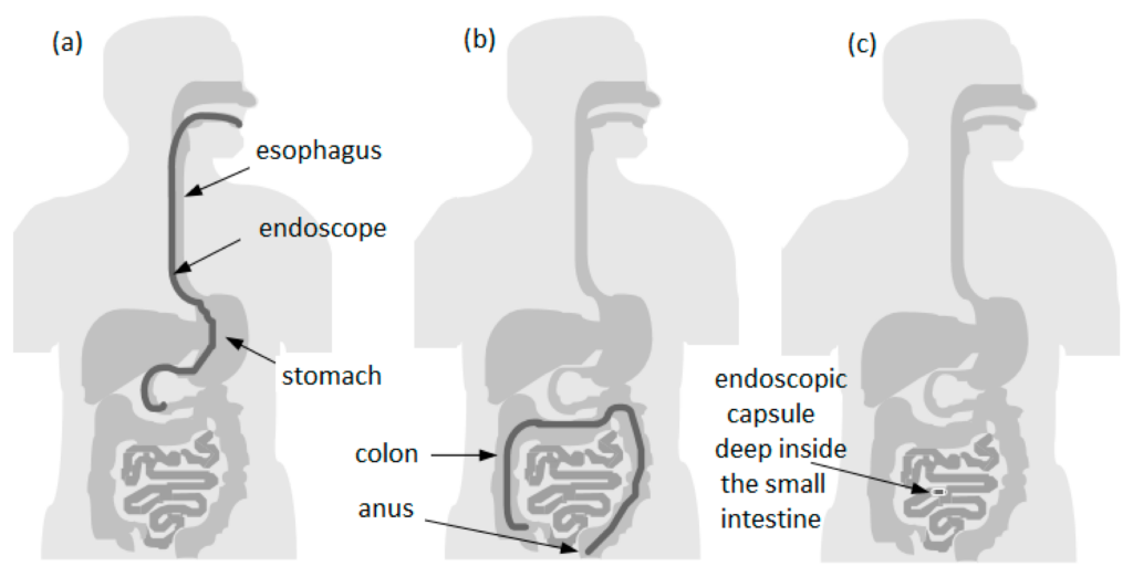 Comparison between covered areas of the diagnostic with endoscopy and endoscopic capsule