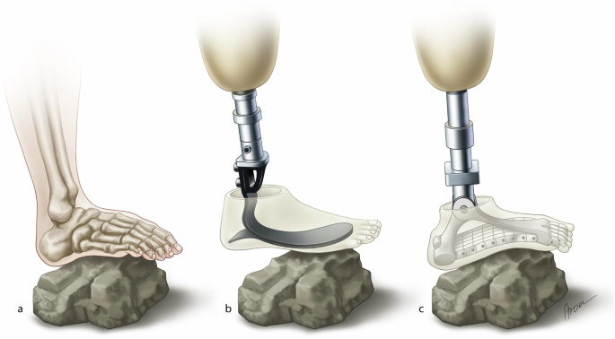 SoftFoot Pro - Adaptative prosthetic