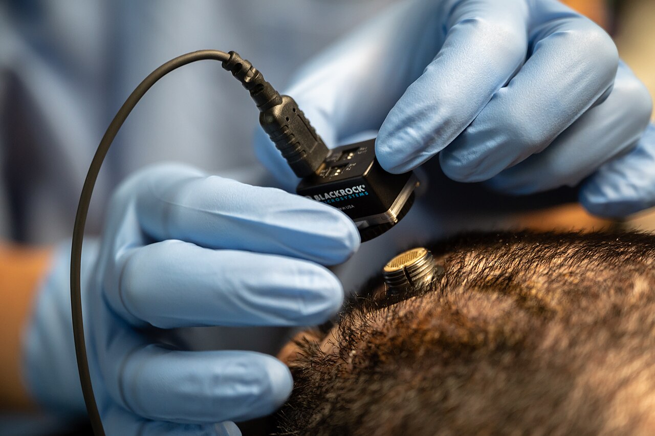 When Your Brain Becomes the Hearing Aid: How Brain-Computer Interfaces Could Transform Neurology